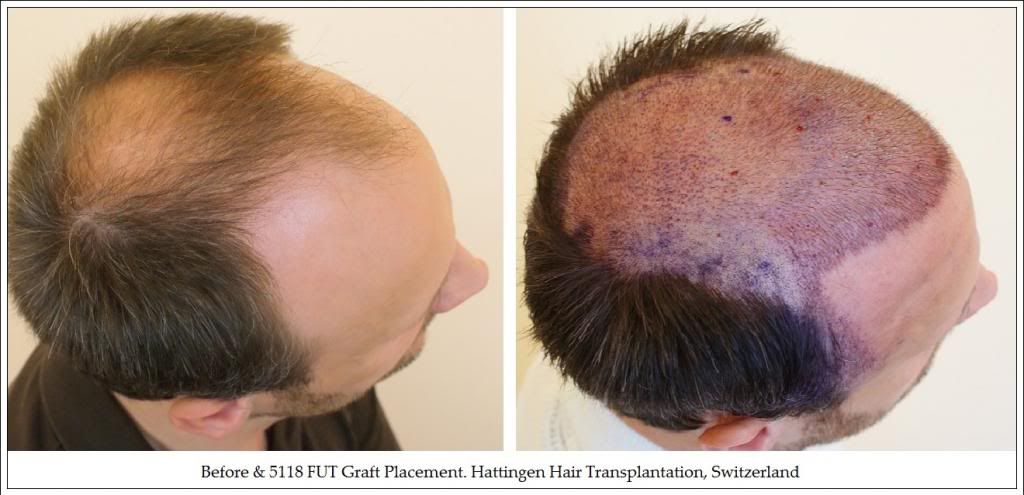 4Beforeamp5118FUTGraftPlacementHattingenHairTransplantationSwitzerland_zpsfcfb7301.jpg