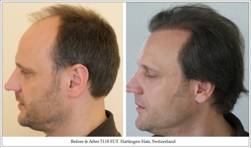 9BeforeampAfter5118FUTHattingenHairSwitzerland_zps568dc02f.jpg