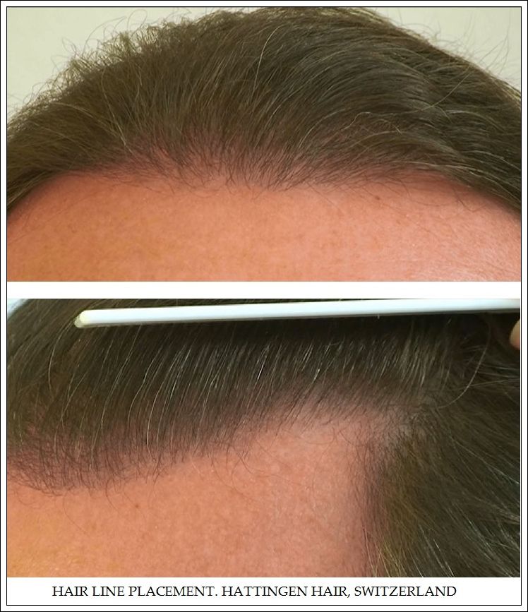 HAIRLINEPLACEMENT_zpsd18498a8.jpg