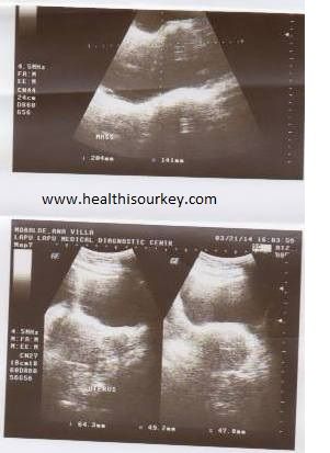 a big tumor found in my younger sister's ovary a big tumor found in my younger sister's ovary