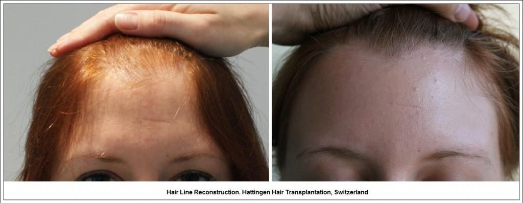 HairLineReconstructionHattingenHairTransplantationSwitzerland_zps71e543fe