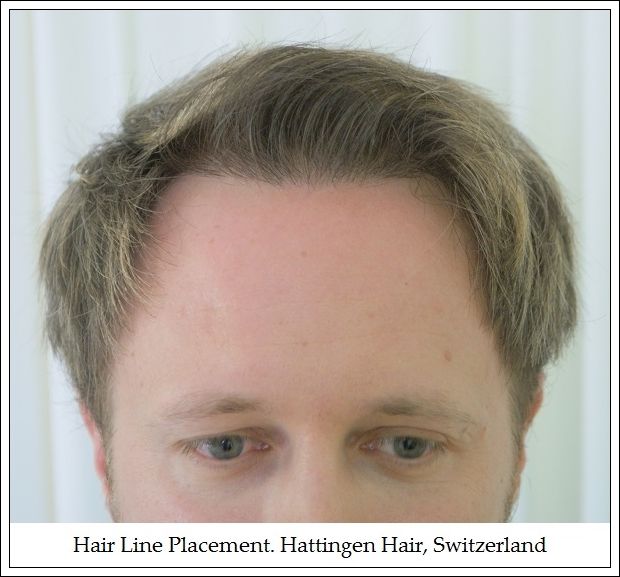 HairLinePlacementHattingenHairSwitzerland_zps7e71617f