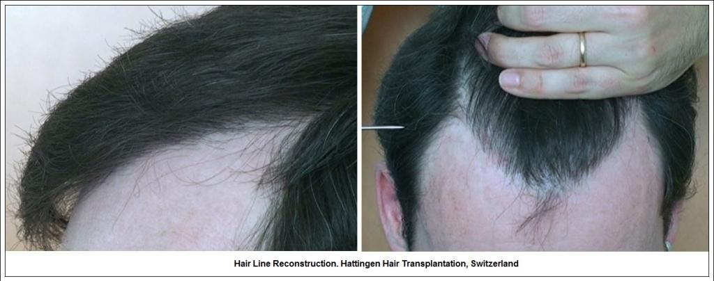 HairLineReconstructionHattingenHairTransplantationSwitzerland_zpsd09a6df2