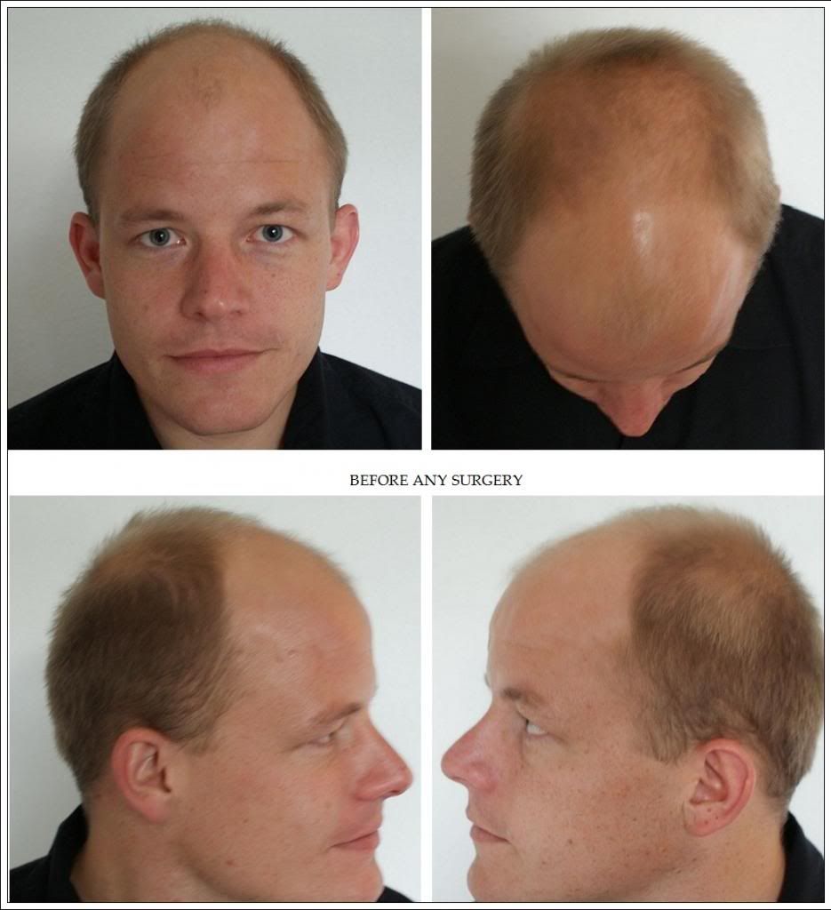Hair loss forum, learn all about hair loss remedies